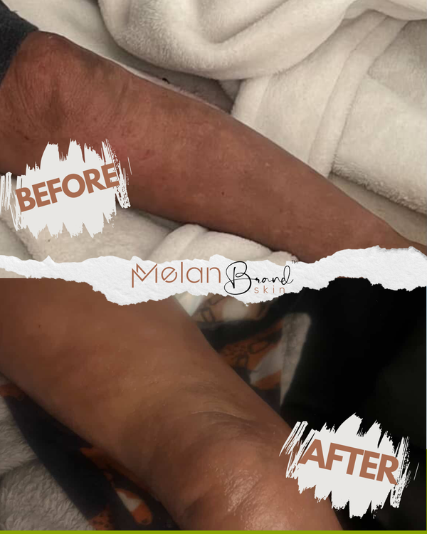 MelanMoisture Extreme Cream